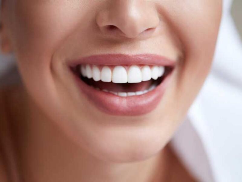 Dental veneers in Javea